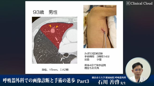 呼吸器外科での画像診断と手術の進歩 Part3 | Clinical Cloud 呼吸器外科での画像診断と手術の進歩 Part3 | Clinical Cloud