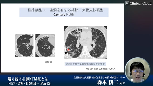 増え続ける肺NTM症とは～疫学・診断・自然経過～　Part2