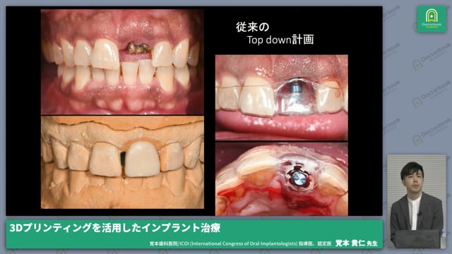 3Dプリンティングを活用したインプラント治療