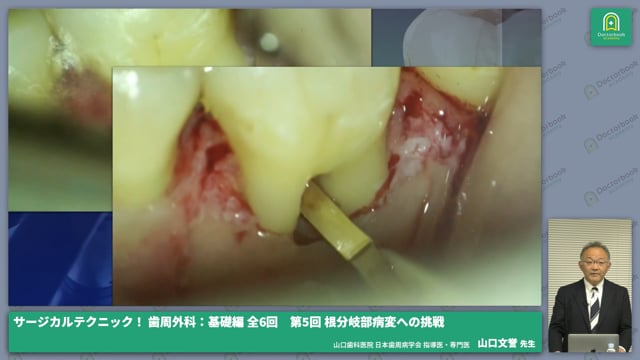 サージカルテクニック！ 歯周外科：基礎編 第5回 根分岐部病変への挑戦