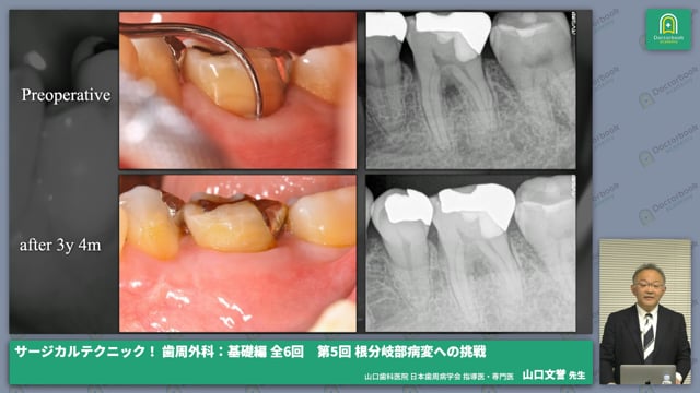 サージカルテクニック！ 歯周外科：基礎編 第5回 根分岐部病変への挑戦