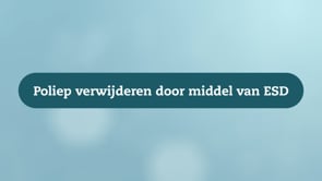 Poliep verwijderen door middel van ESD