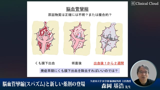 脳血管攣縮 (スパズム)と新しい薬剤の登場