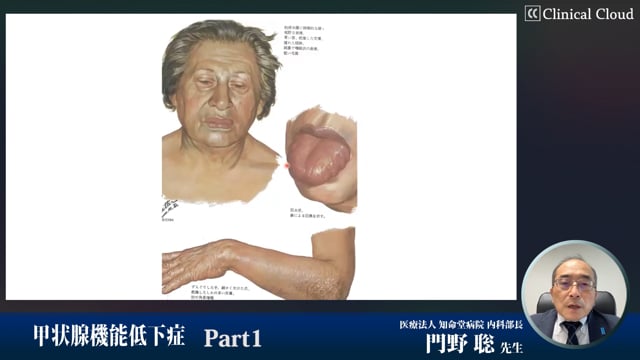 甲状腺機能低下症　Part1