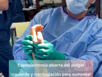 Paciente tiene rigidez en el pulgar y logra mover despues de una capsulectomia