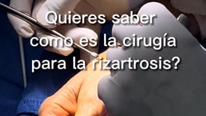 El paciente presenta rigidez en el pulgar y es capaz de moverlo tras una capsulectomía.