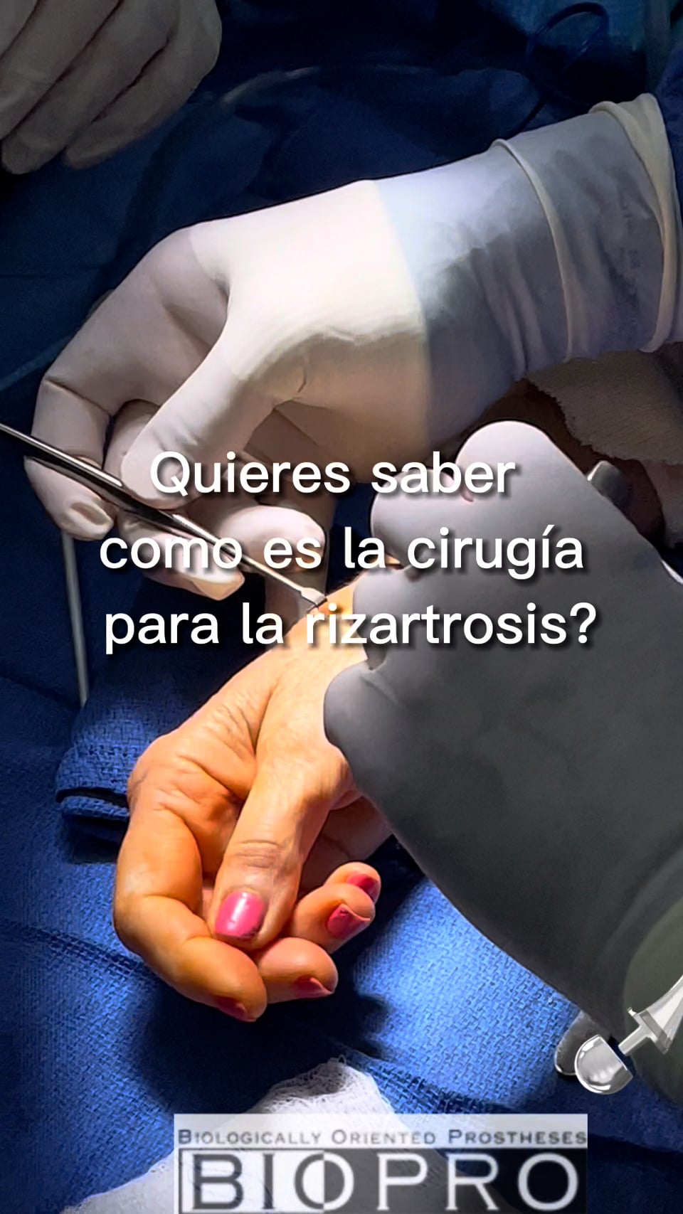 Patient has stiffness in the thumb and is able to move it after a capsulectomy.