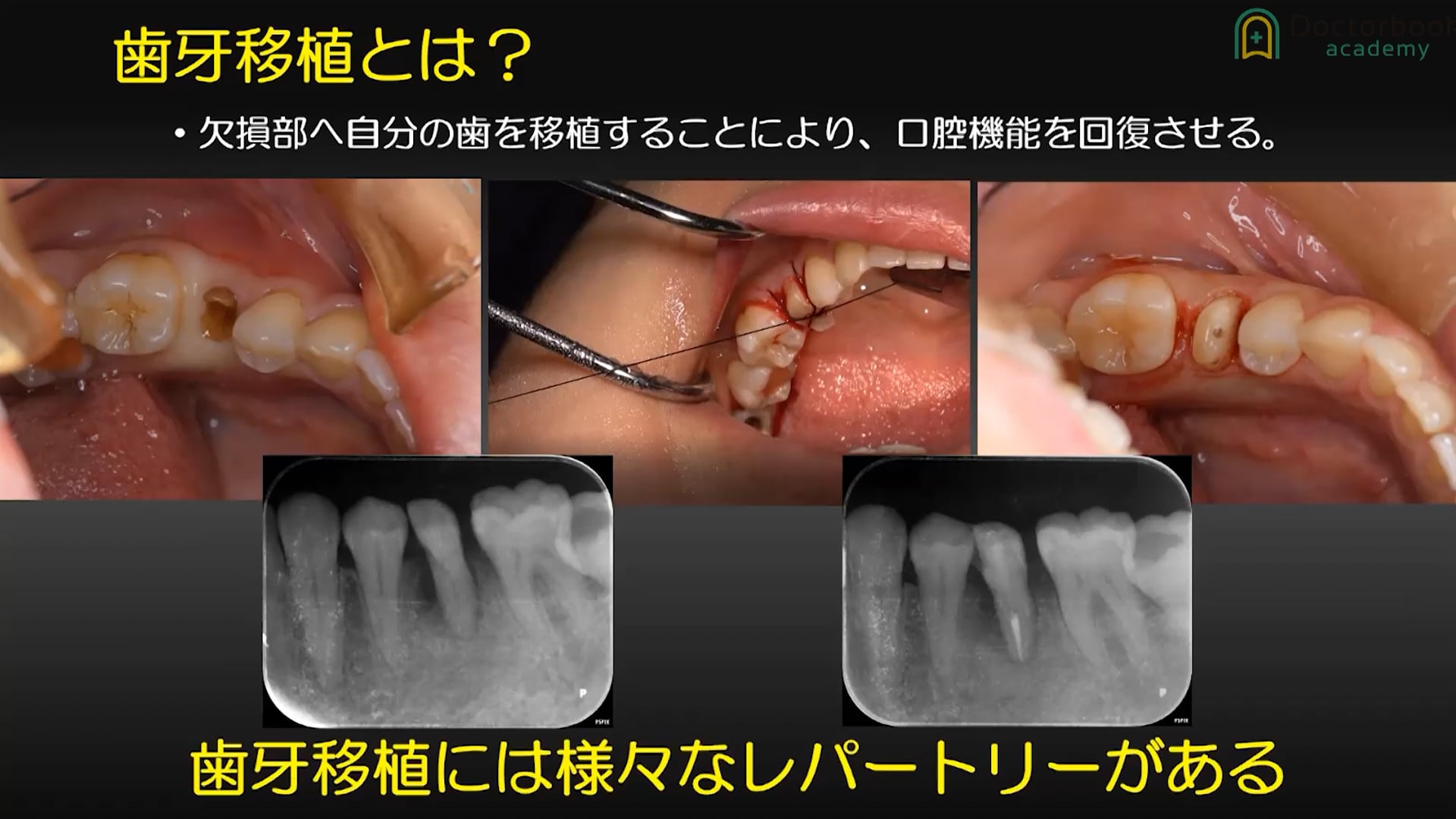 若手から始める自家歯牙移植術〜成功への鍵〜 #1