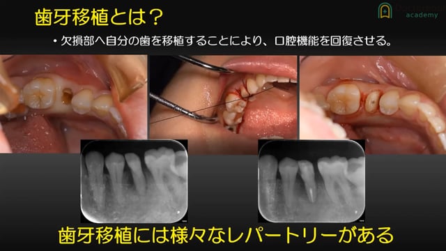 若手から始める自家歯牙移植術〜成功への鍵〜 | Doctorbook academy (ドクターブックアカデミー)