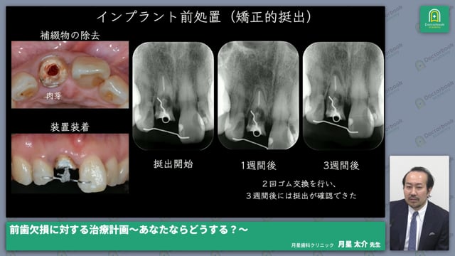 前歯部が外傷で脱落し再植を行った症例・抜歯即時埋入インプラント時にCTGを行った症例・自家再移植症例│月星 太介先生 #1