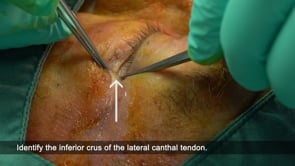 Procedure: Lateral Canthotomy