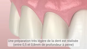 Les facettes dentaires