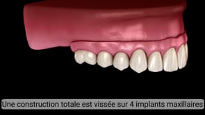 La prothèse sur implants