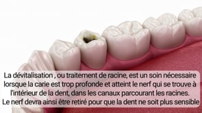 La dévitalisation