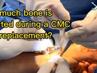 How much bone is removed during a thumb joint replacement procedure?