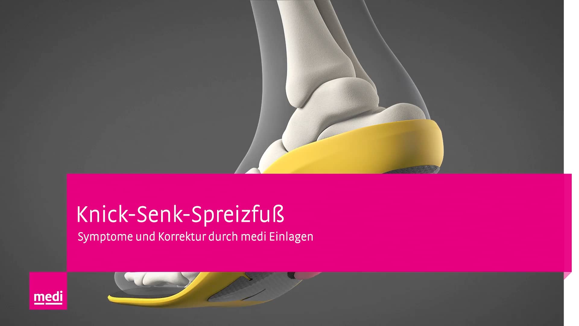 Fußfehlstellungen – Knick-Senk-Spreizfuß, Therapie mit igli Carbon ...