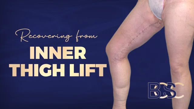 Where Are the Scars for a Thigh Lift?