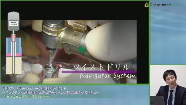 ガイデッドサージェリーの臨床的ポイント -インプラントの性能を最大限に活かすための治療戦略と埋入術式- #4