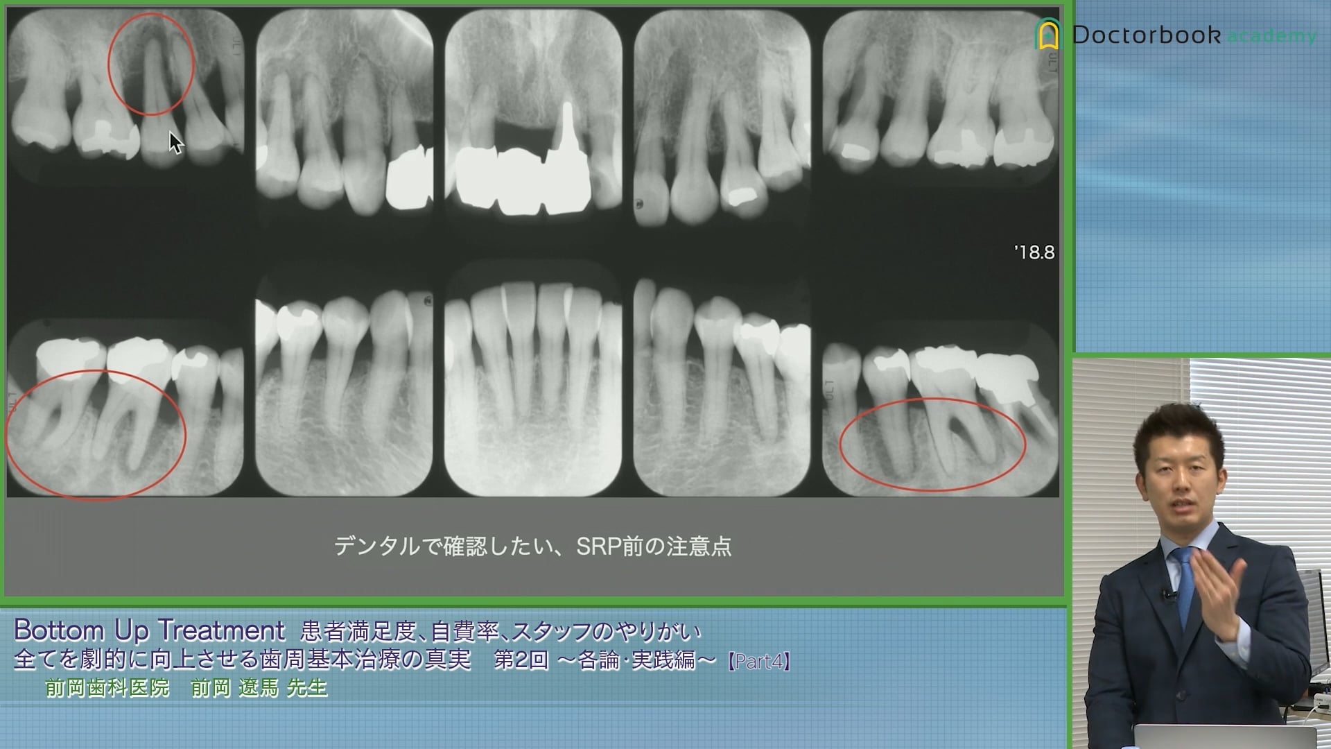 患者さんの意識レベルに応じたブラッシング指導・TBI #4