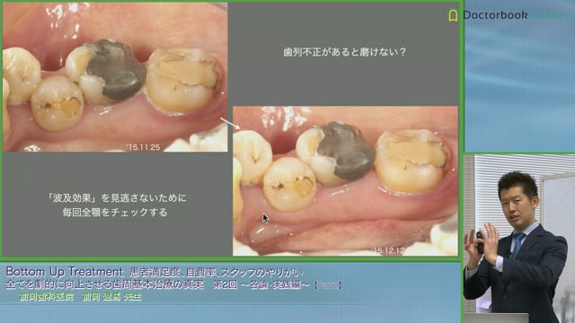 歯周基本治療における初診時のポイントとTBIのポイント #2