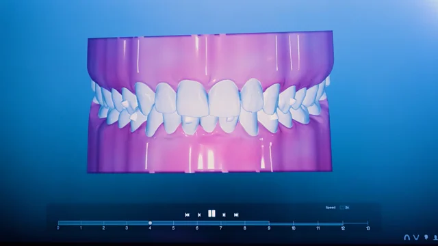 Facettes dentaires - Clinique dentaire ST-ÉTIENNE