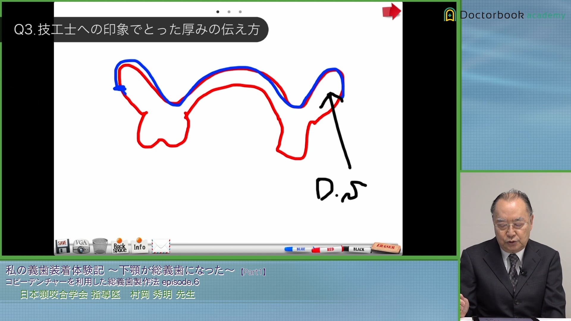 顎堤吸収の著しい下顎総義歯作製のコツ #1 | Doctorbook academy