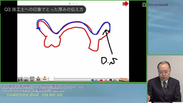 顎堤吸収の著しい下顎総義歯作製のコツ #1