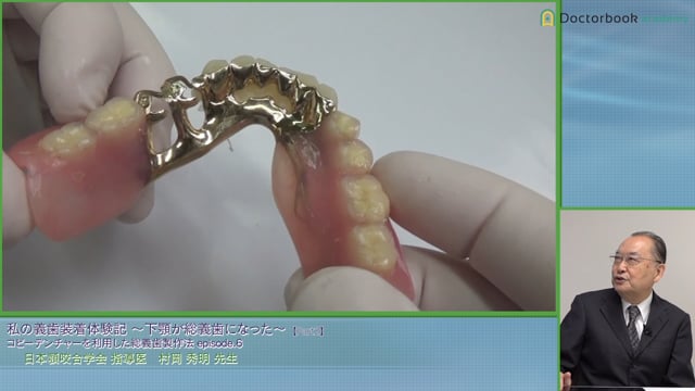 人工歯排列を変える前に大事なことと部分床義歯の使用感 #2