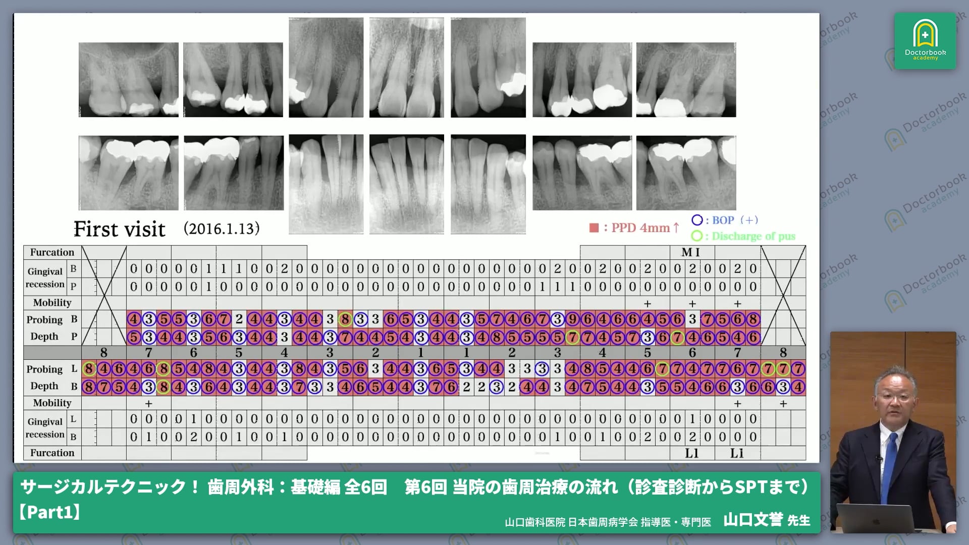 重度歯周病症例に対する診査診断から治療計画の策定 #1