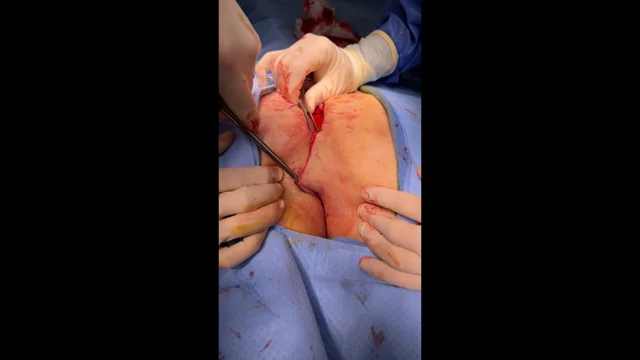 Treating pilonidal sinus wounds with an antibacterial wound gel after  incision and drainage