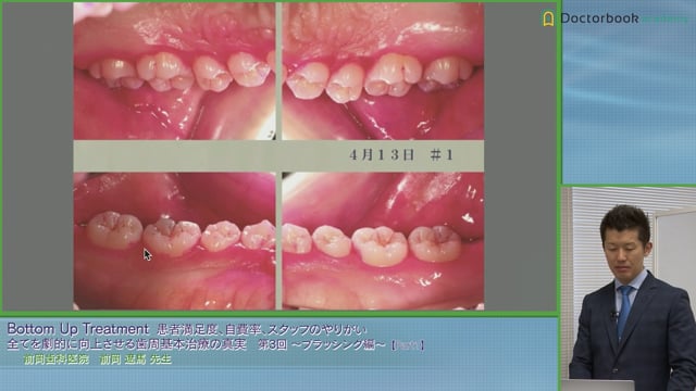 歯周基本治療の最初の一歩「術者の100％磨き」 #1