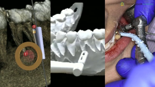 3Dガイドテンプレートを用いた左上第二小臼歯の歯根端切除手術 #1
