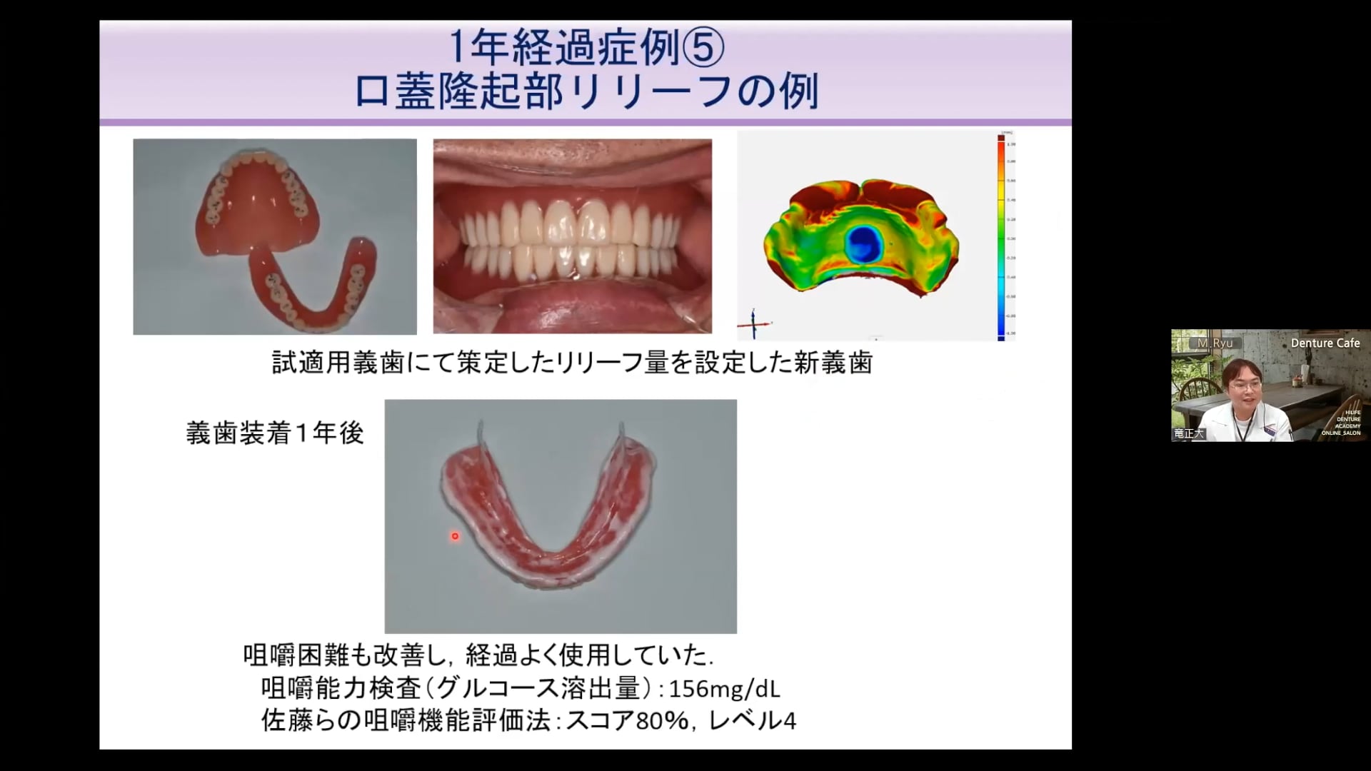 1年使ってわかった3D printed denture の世界│竜正 大先生 #2