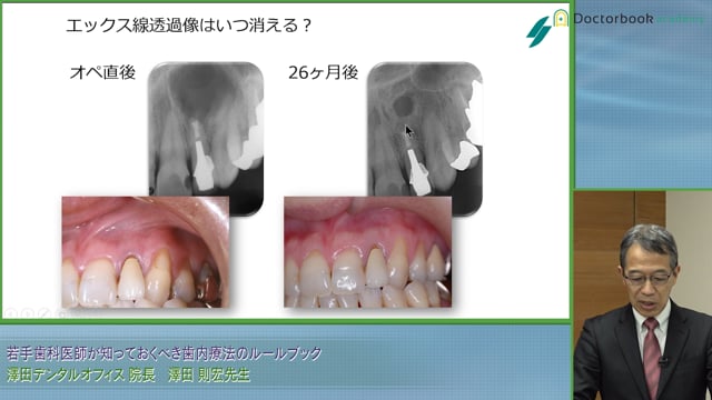 若手歯科医師が知っておくべき歯内療法のルールブック #2