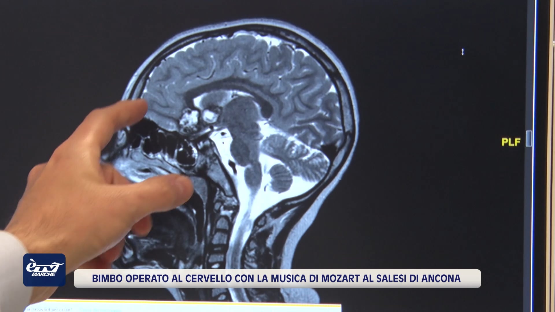 Bimbo operato al cervello con la musica di Mozart al Salesi di Ancona - VIDEO
