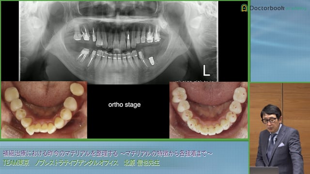 コロナルリーケージの影響と支台築造における接着の重要性 #3