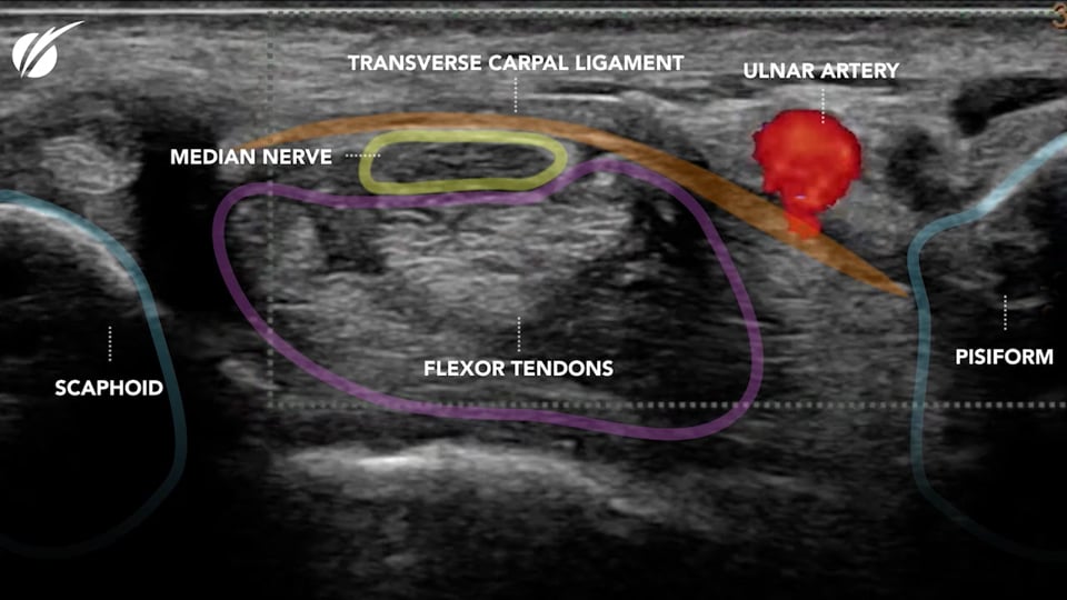 Why not just stick with The endoscopic approach?