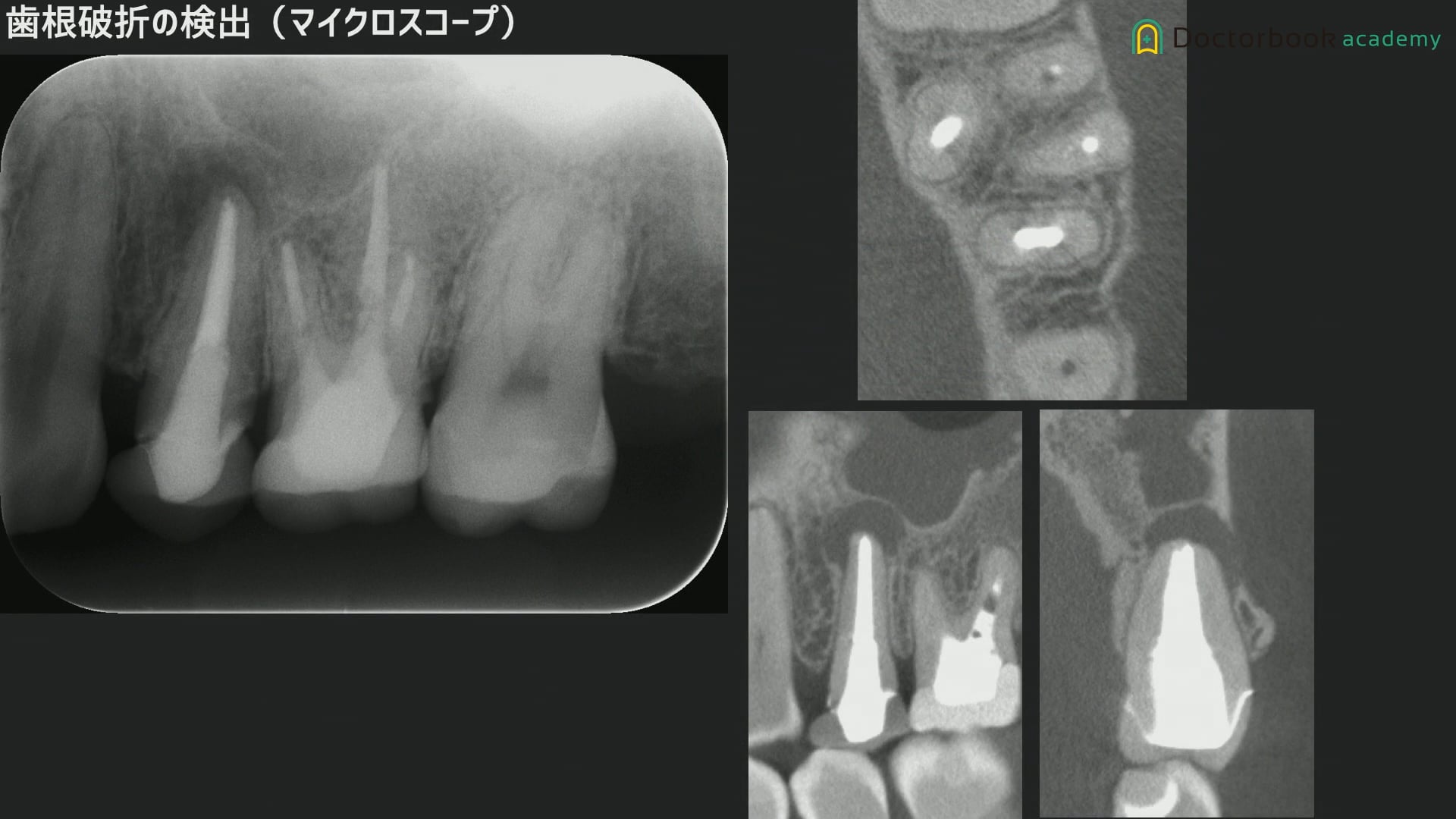 逆根管治療の選択と術式、必要な機器や器具 #1