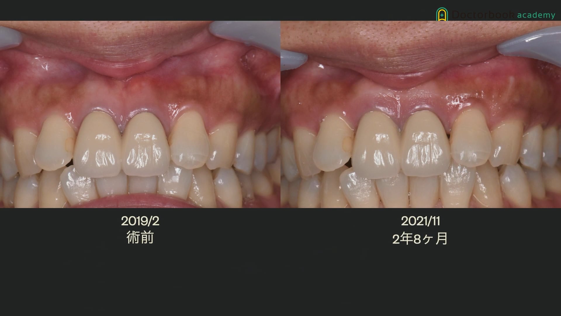 歯根肉芽腫と歯根嚢胞の鑑別、逆根管治療が必要な３つの理由 #2