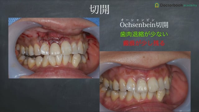 逆根管治療の実践と手順│様々な切開法とCBCTによる診断 #4