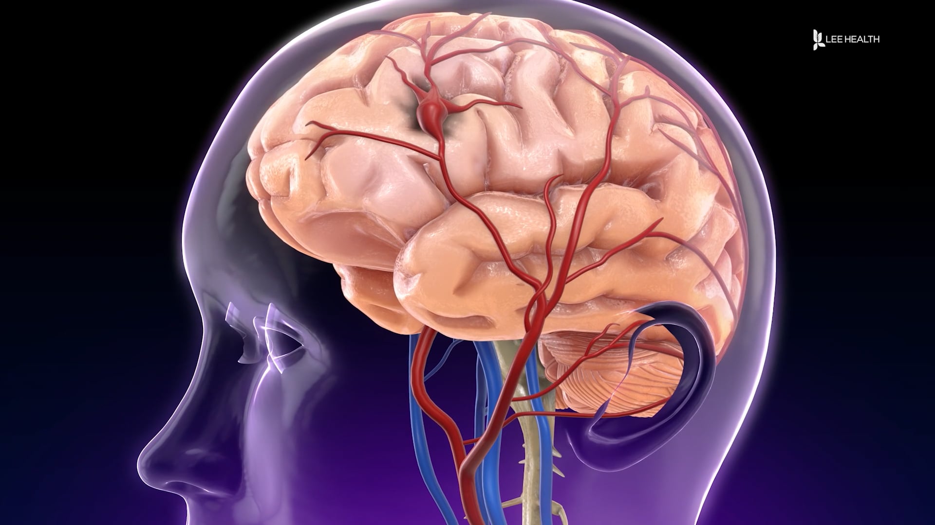 what-is-a-brain-aneurysm-on-vimeo