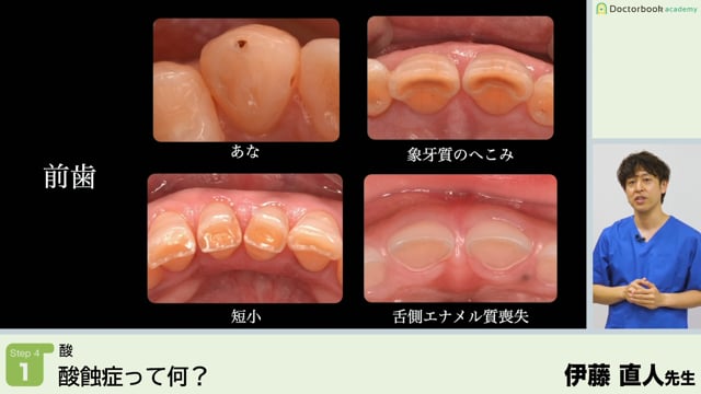 酸蝕症って何？│Step4-1