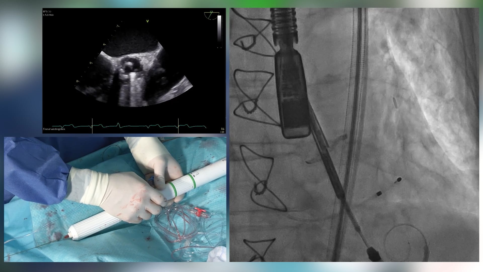 Leaflet splitting device to prevent coronary artery obstruction in