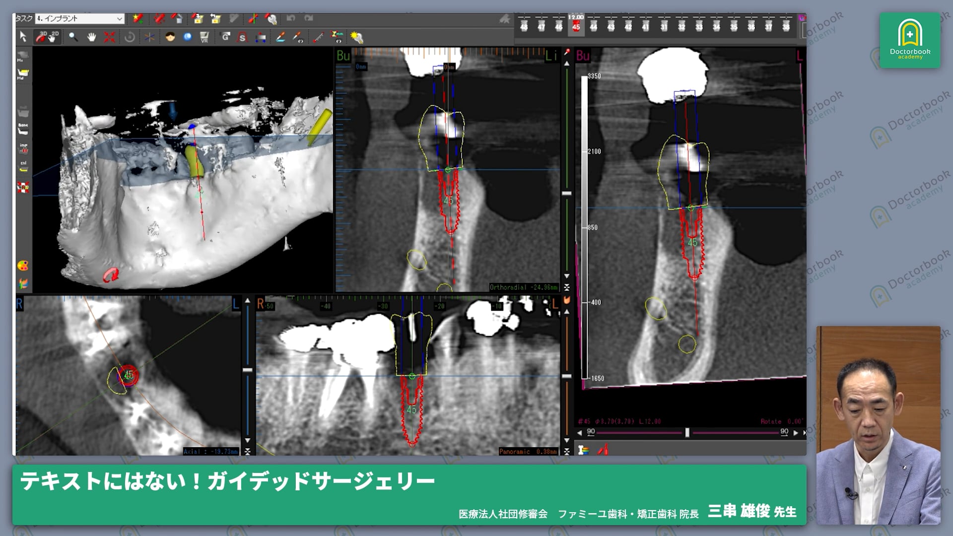 デジタルワークフロー｜シュミレーションから補綴までデジタルデータで一気通貫　IOSで印象、補綴まで #2