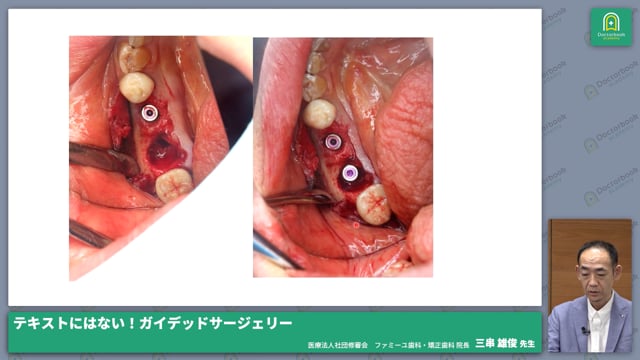 ガイドを使ったオペ事例｜抜歯即時ケース　左側埋入ポジション　ボーンコンデンス、アダプテーションテクニック　ソケットリフト #3