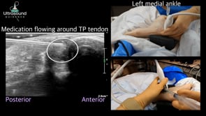 Tibialis Posterior Tendon Sheath Injection