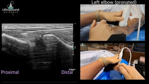 Common Extensor Tendon Needle Tenotomy Long Axis