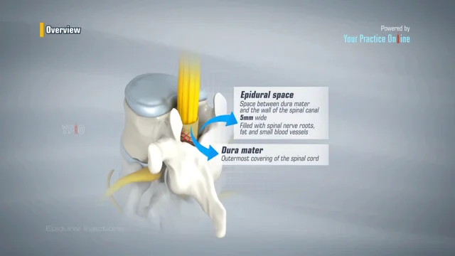 Spinal Stenosis - The Woodlands, TX