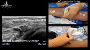 Baker Cyst Drainage and Injection