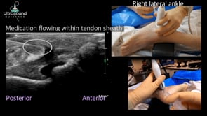 Fibularis/Peroneal Tendon Sheath Injection